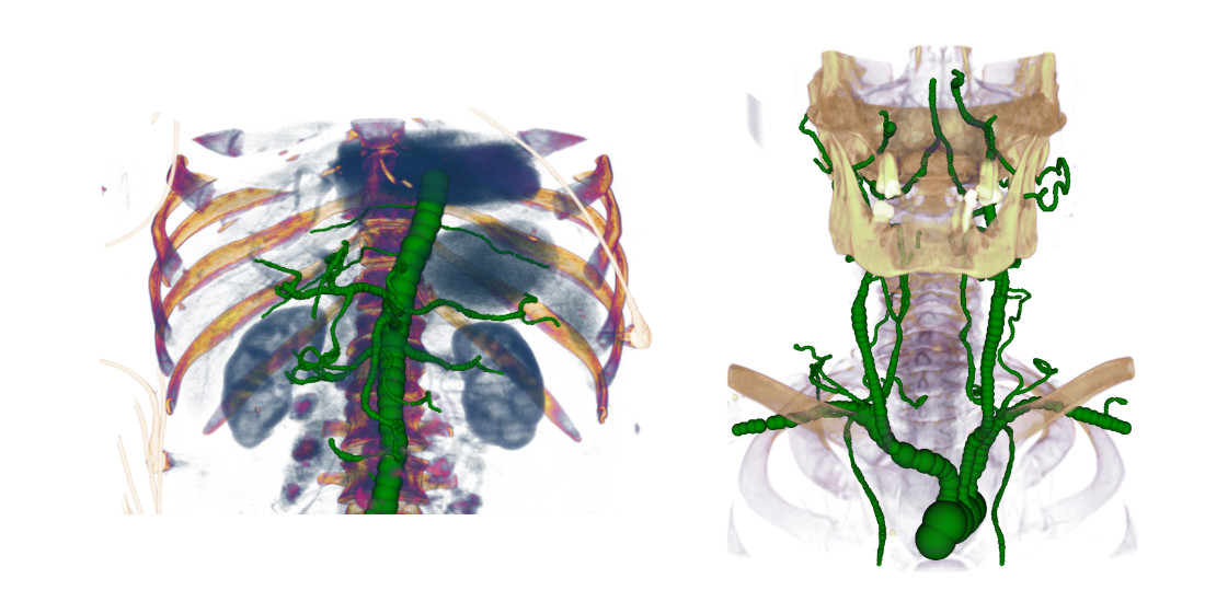 Zwei Aufnahme des menschlichen Skeletts mit segmentierten und farblich hervorgehobenen Arterien.