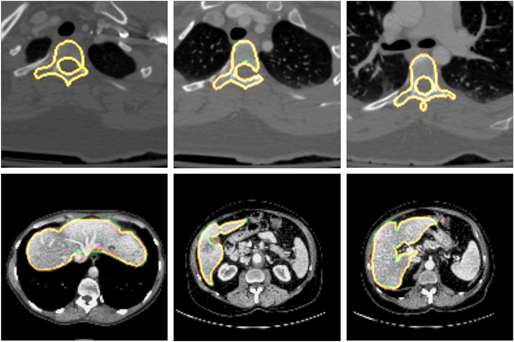 Zu sehen sind zwei Reihen á 3 CT-Scans, die Aufnahmen der Wirbelsäule und Leber zeigen sowie mehrere farbige Markierungen, welche die entsprechenden Organe segmentieren.