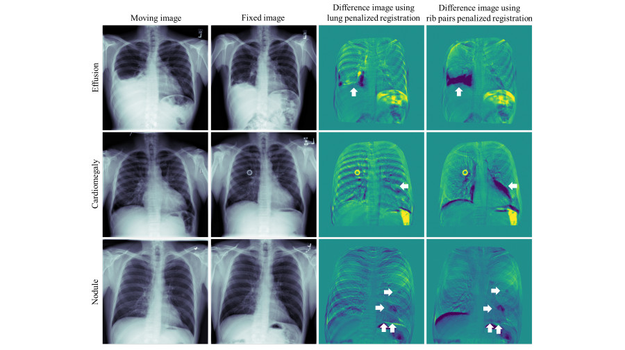 Zu sehen sind zwei Spalten an medizinischen Röntgenbildern des Brustbereichs, daneben sind zwei Spalten von medizinischer Bildregistrierung derselben Aufnahmen.