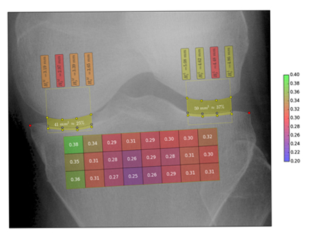 Visualisierung des Verfahrens, wie Visual Computing-Techniken zur automatisierten Erkennung von Osteoporose und Osteoarthritis eingesetzt werden.