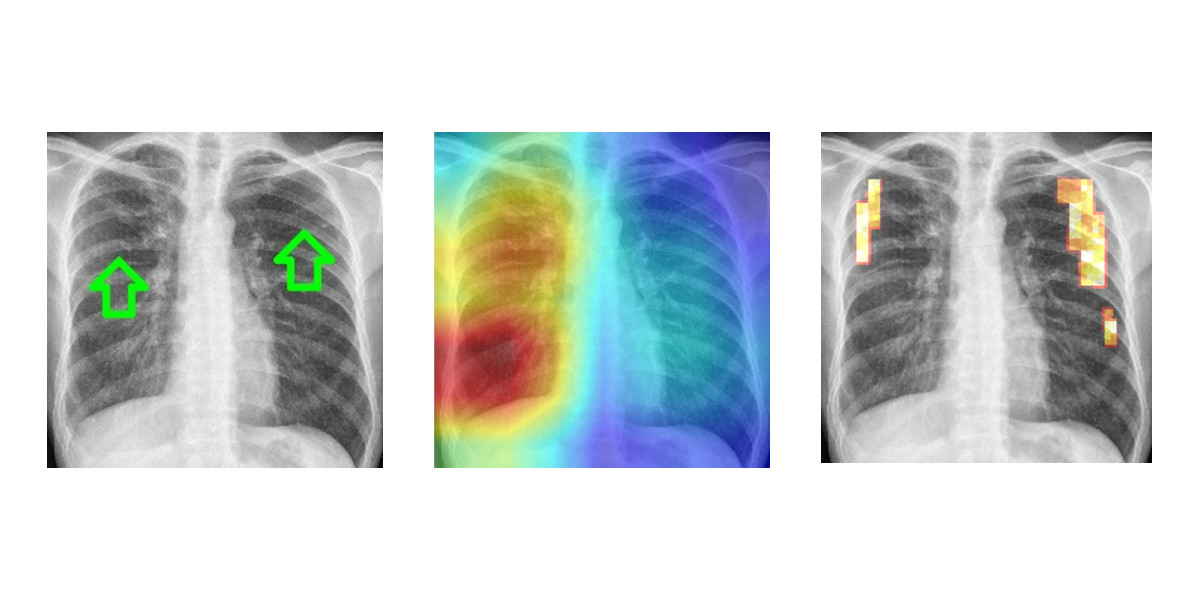 Drei Röntgenaufnahmen des Brustbereichs nebeneinander, auf welchen Tuberkulose-erkrankte Stelle auf unterschiedliche Art und Weise eingezeichnet/klassifiziert sind.
