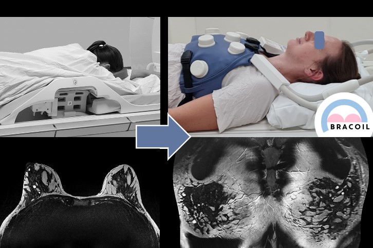 Zwei MRI Bilder einer Brust, angefertigt mit der Hardware BraCoil, die Hardware ist auf einem Foto zu sehen