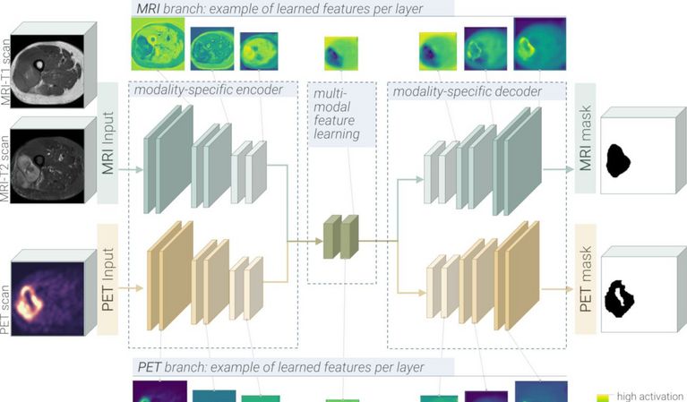 Darstellung der Architektur eines neuronalen Netzwerkes, welches in verschiedenen Schritten Tumore auf medizinischen Bildern segmentieren kann.